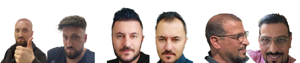 volti affiancati per prima dopo trapianto capelli